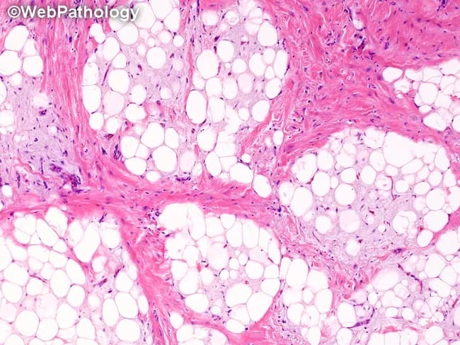 This histopathology image depicts a lipoblastoma arising in soft tissue, analyzed by light microscopy after Hematoxylin and Eosin staining. The specimen shows a lobulated adipocytic proliferation with irregular lobules separated by dense fibrous septa. Within each lobule, adipocytes are present in multiple maturation stages, ranging from primitive, stellate or spindle-shaped mesenchymal cells (preadipocytes) to multivacuolated lipoblasts and mature univacuolated adipocytes. Some lipoblasts exhibit signet-ring morphology with cytoplasmic lipid vacuoles pushing the nucleus to the periphery. The proportion of cells at each maturation stage varies both between lobules and within a given lobule, producing a heterogeneous histologic appearance. The fibrous septa may contain sparse spindle cells and delicate capillaries but show no overt cytologic atypia, mitotic figures, necrosis, or infiltrative invasion. This combination of lobulated architecture, lipoblast-rich adipose tissue, and absence of malignant features is characteristic of lipoblastoma, a benign pediatric adipocytic tumor. Clinically, these histologic features support diagnosis and guide management toward conservative excision with careful margin assessment to minimize recurrence. Differential considerations include myxoid liposarcoma in older patients or atypical lesions; molecular testing (e.g., PLAG1 rearrangement) can aid confirmation. Overall, the image illustrates classic histology with diagnostic significance for pediatric soft tissue tumors.
