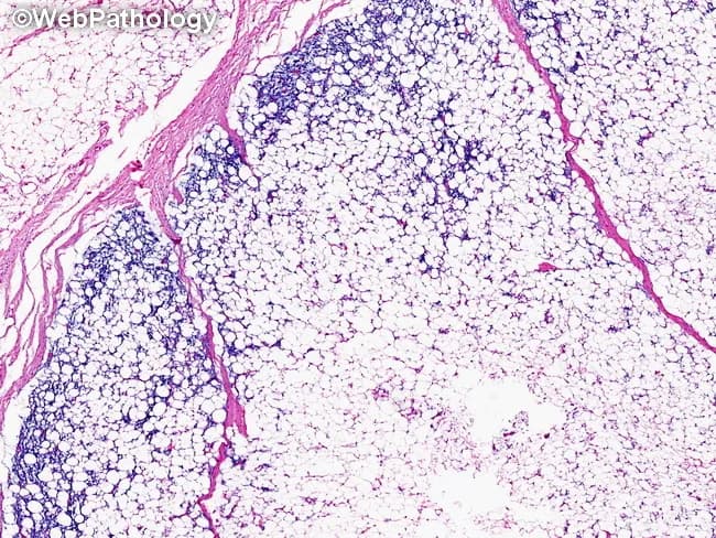 This is a hematoxylin and eosin (H&E) stained histology section of soft tissue lipoblastoma. The tissue is organized in lobules separated by delicate fibrous septa. Peripheral zones contain primitive mesenchymal cells with small oval to spindle nuclei, scant cytoplasm, and a high nuclear-to-cytoplasmic ratio, whereas central cores consist of mature adipocytes with clear lipid vacuoles. Lipoblasts with multivacuolated cytoplasm indent the nucleus, producing a scalloped silhouette. The observed zonal maturation pattern—immature cells at the periphery transitioning toward mature adipocytes centrally—supports a benign adipocytic neoplasm. The stroma may be variably myxoid or fibrous, and mitotic activity is not prominent. No overt cytologic atypia or necrosis is evident at this magnification. Overall architecture favors lipoblastoma, a pediatric-origin tumor of adipose tissue, frequently arising in subcutaneous soft tissue of limbs or trunk. Clinically, this histology helps differentiate from liposarcoma, where cellular atypia, mitotic activity, and dedifferentiation may be present, particularly in older patients. The image therefore has diagnostic relevance for surgical planning, prognosis, and longitudinal surveillance in pediatric patients, and it illustrates classic lipoblast maturation with peripheral immature cells and central mature adipocytes, a hallmark of this entity. Awareness of this pattern aids pathologists in reporting and guiding targeted excision with clear margins to guide therapy.