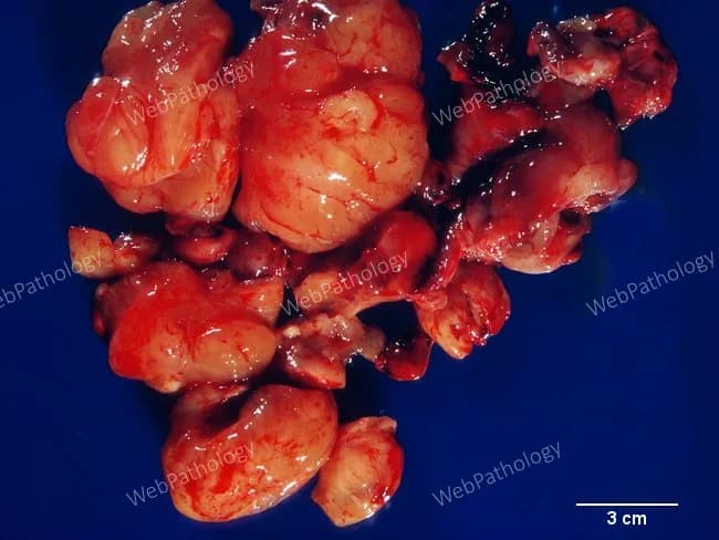 This is a macroscopic, ex vivo photograph of a thigh soft tissue liposarcoma resection specimen from a 68-year-old man. The tumor is composed of multiple lobulated, adipose-dense nodules with a yellow-tan, greasy appearance and glistening surfaces, separated by pale fibrous septa. The nodules vary from a few centimeters to several centimeters in greatest dimension; a 3 cm scale bar allows size estimation. The surface is largely smooth, with occasional gentle indentations and minor hemorrhagic streaks, consistent with a large, deep-seated lipomatous tumor. Although gross features mimic benign lipomas, histologic correlation (not shown in this image) demonstrates a well-differentiated liposarcoma characterized by mature adipocytes interspersed with scattered lipoblasts and fibrous septa containing atypical stromal cells. This ex vivo image illustrates the gross-pathology correlation used in surgical planning: complete excision with negative margins, assessment of tumor size and nodularity, and integration with genetic/immunohistochemical testing (e.g., MDM2, CDK4) to differentiate from lipoma and guide prognosis. Clinically, thigh liposarcomas occur in older adults and are typically large and deep to muscle; they require long-term follow-up due to local recurrence risk, potential for regional spread, and the need for adjuvant therapy decisions based on histologic subtype and margin status.