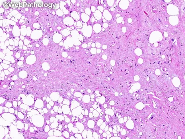 Histopathology image of a soft tissue tumor from a thigh shows mature adipocytes with variable size and scattered lipoblast-like cells embedded in variably dense fibrous septa. The specimen demonstrates a mixed morphology with lipoma-like adipose tissue interlaced by sclerosing areas containing thick, hyalinized collagen and sparse spindle cells. Adipocytic atypia is mild, with slightly enlarged, hyperchromatic nuclei, but there is no overt pleomorphism or high-grade mitotic activity. The fibrous stroma often blends with focal myxoid zones, yielding a mosaic pattern characteristic of the ALT/WDL spectrum. Overall, regions rich in adipose elements alternate with dense, fibrous septa and sclerotic foci, reflecting the combining lipoma-like and sclerosing components described in well-differentiated liposarcoma. The image does not demonstrate definitive dedifferentiation within the sampled fields. Clinically this correlates with a large, deep-seated thigh lipomatous tumor in an older adult. Distinguishing ALT/WDL from benign lipoma typically requires molecular confirmation of MDM2/CDK4 amplification or fluorescence in situ hybridization, in addition to histologic assessment of atypia and lipoblasts. Surgical excision with clear margins is recommended due to local recurrence risk. This image emphasizes the diagnostic spectrum and supports integrated histopathology and molecular testing in soft tissue sarcoma workup. Correlation with clinical history strengthens diagnostic confidence and management.