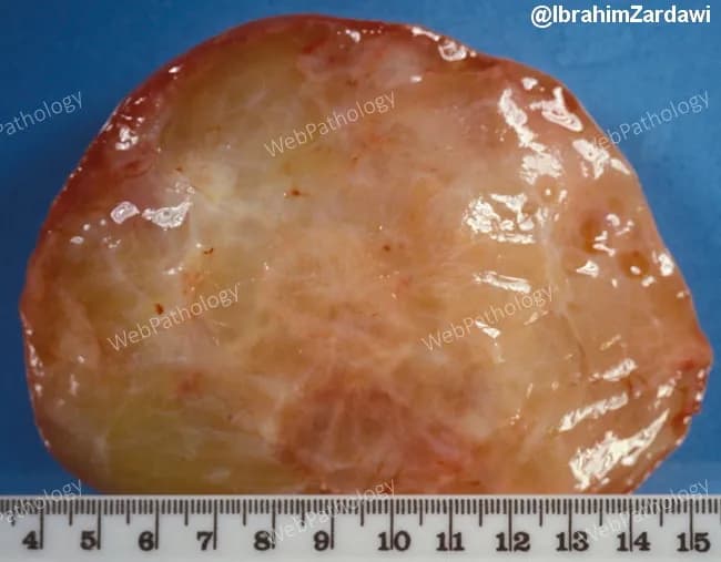 Gross pathology photograph of a myxoid liposarcoma in a soft-tissue tumor specimen. Modality: gross examination with photographic documentation. The specimen is a well-circumscribed soft mass, measuring roughly 8–9 cm in greatest dimension, with a glistening, gelatinous cut surface that reflects abundant myxoid extracellular matrix. The exterior is tan-pink and slightly translucent, with a lobulated contour and a moist, glossy surface. The cut surface reveals a homogeneous, mucinous pale-yellow to pinkish material interspersed with sparse adipose elements; there may be minor hemorrhagic foci at the periphery. The margins appear relatively well defined in the specimen, though in vivo growth can be infiltrative. Overall, the gross morphology is consistent with myxoid liposarcoma, a malignant adipocytic tumor characterized by a plentiful myxoid stroma and delicate capillary networks. This gross pattern correlates with the characteristic histology of myxoid liposarcoma: abundant myxoid stroma containing delicate capillaries and scattered lipoblasts at the microscopic level. Clinically, recognizing this gross pattern aids in prompt pathologic triage, surgical planning, and prognosis. This image is valuable for education in soft tissue sarcomas, tumor grossing technique, and radiopathology correlation, and it supports teaching datasets and searchable image repositories for pathology training, case-based learning, and medical informatics. Educational value assured.