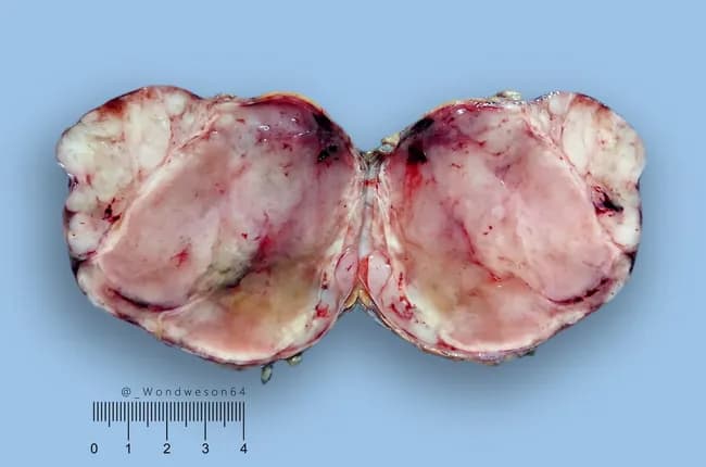 Gross pathology: A thigh soft tissue mass from a 43-year-old male displays a well-circumscribed, encapsulated lesion measuring 8 cm by 8 cm by 5 cm. The external surface is pink-tan with a lobulated, gelatinous cut surface containing focal hemorrhage. The specimen is consistent with a deep-seated lipomatous neoplasm. On microscopic examination, the tumor is diagnosed as myxoid liposarcoma. The peripheral whitish nodules correspond to hypercellular foci, whereas the central myxoid stroma remains relatively hypocellular. There is no definite round cell component identified in this specimen. The myxoid matrix is characterized by abundant mucopolysaccharide-rich ground substance with a delicate capillary network; lipogenic cells show variable adipocytic differentiation. A circumscribed capsule and well-preserved tissue architecture support a localized lesion. Additional ancillary testing (e.g., molecular cytogenetics for FUS-DDIT3 rearrangement) may confirm diagnosis and assist in grading, prognosis, and therapeutic planning. Clinically, myxoid liposarcoma evokes intermediate to low-grade aggressiveness, with potential for local recurrence and distant metastasis, underscoring the importance of complete excision with negative margins. This gross description provides essential context for correlating histology, staging, and treatment strategies in soft tissue sarcoma management. Correlative imaging, margin status, and molecular profile will guide adjuvant therapy decisions and surveillance to optimize outcomes in this case.