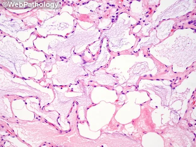 Imaging modality: Light microscopy of hematoxylin-eosin stained histology section from a soft tissue biopsy containing a liposarcoma with prominent myxoid matrix. Anatomical context: soft tissue tumor, unspecified site, intratumoral myxoid stroma with mucin pooling. Visual features: abundant mucin pools create cribriform or lacelike architecture; flat tumor cells line mucin pools with intermittent rounded cells at the pool rims; pseudoacinar patterns arise at the mucin borders; in some areas, a lymphangioma-like appearance is observed; occasional cystic spaces and edema-like basophilic mucin mimic pulmonary edema histology. These features are typical of myxoid liposarcoma; adipocytic differentiation may be seen; scattered delicate capillary networks may accompany the mucin pools. This histology supports diagnosis of myxoid liposarcoma, a soft tissue sarcoma characterized by abundant myxoid stroma and a plexiform capillary network; the mucin-rich milieu contributes to a clear-to-pale appearance on H&E. Diagnostic significance: recognition of myxoid matrix with pooling mucin and cribiform pattern aids distinction from myxofibrosarcoma and other myxoid sarcomas; differential diagnoses include myxoid chondrosarcoma or metastatic mucinous carcinoma depending on location. Clinical correlation: correlate with tumor size, site, and imaging (MRI features of high T2 signal with heterogenous enhancement); prognosis varies with histologic grade and presence of lipoblasts. Potential clinical use cases include diagnostic confirmation and educational illustration for soft-tissue pathology.