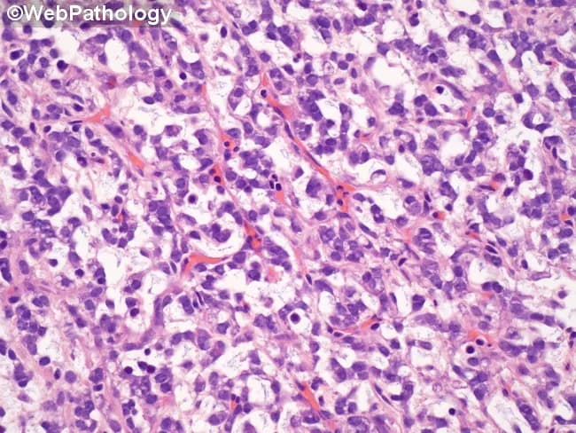 Histopathology image depicts a high-grade myxoid liposarcoma, round cell predominant. Using light microscopy, sections stained with hematoxylin and eosin show primitive-appearing tumor cells arranged in cords, nests, and short trabeculae within a variably myxoid matrix. The tumor displays a delicate, plexiform capillary network typical of myxoid liposarcoma, with prominent branching, thin-walled vessels in a myxoid stroma. Cells are small to medium-sized with hyperchromatic, elongated to round nuclei, scant cytoplasm, and conspicuous mitotic activity in high-grade areas. Occasional lipoblast-like cells may be seen; lipogenic differentiation is variably evident. The background myxoid stroma appears pale pink to blue with abundant mucopolysaccharide matrix. Necrosis is minimal or focal. The lesion lacks overt adipocytic maturation in the high-grade component. Immunohistochemistry is not provided in image, but typical profiles show variable S-100 positivity; molecular hallmark is the FUS-DDIT3 fusion gene due to t(12;16)(q13;p11). Clinically, this histology portends a higher risk of metastasis and recurrence compared to conventional, low-grade myxoid liposarcoma. Potential differential diagnoses include round cell variants of other soft tissue sarcomas such as synovial sarcoma, Ewing/PNET, and malignant peripheral nerve sheath tumor, requiring molecular testing to confirm. The image is educational for pathology education, tumor histology, and diagnostic pathology training; relevant for surgical oncology planning and radiation therapy decisions.