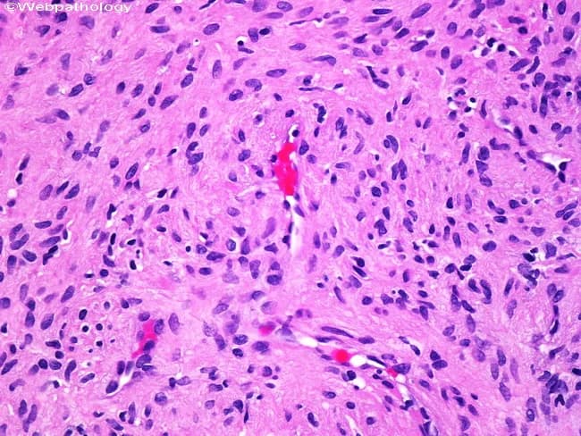 This histopathology image depicts a cutaneous smooth muscle tumor (leiomyoma) on light microscopy. The tissue shows interlacing fascicles of spindle-shaped smooth muscle cells with eosinophilic cytoplasm and elongated, blunt-ended nuclei. Cellular atypia is absent or minimal; occasional degenerative nuclear atypia may be present, but mitotic activity is not evident. The tumor is well circumscribed within dermal/subcutaneous tissue, and nerves are evident within or adjacent to the lesion, accounting for pain and sensitivity to manipulation described clinically. There is no overt necrosis or high-grade pleomorphism, supporting a benign behavior. The morphological features—uniform spindle cells, organized architecture, and lack of mitotic figures—are characteristic of leiomyoma and help distinguish it from malignant smooth muscle neoplasms such as leiomyosarcoma. Clinically, cutaneous leiomyomas present as firm, painful nodules and are typically cured by simple surgical excision with excellent prognosis; recurrence is uncommon when completely excised. Immunohistochemistry (not shown) would typically reveal smooth muscle actin (SMA) positivity. This image provides educational value for medical students and clinicians in recognizing benign smooth muscle tumors, differentiating from neural or fibrous lesions, and correlating histology with pain syndromes that drive therapeutic management. This correlation supports clinical decision-making and reinforces the benign, curable nature of cutaneous leiomyoma through complete excision.