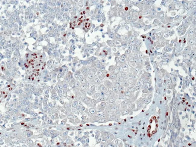Immunohistochemistry for INI1 (SMARCB1) was performed on a renal tumor tissue section. The scan shows complete loss of nuclear INI1 expression in the malignant rhabdoid cells, with intact INI1 staining in admixed stromal cells and in benign renal tubular epithelium serving as internal positive controls. The tumor cells display classic rhabdoid morphology, including large polygonal cells with abundant eosinophilic or amphophilic cytoplasm, vesicular nuclei, prominent nucleoli, and high mitotic activity embedded in a fibrous to myxoid stroma. Immunostaining pattern helps distinguish SMARCB1-deficient rhabdoid tumors from other renal neoplasms. This INI1 loss is characteristic of rhabdoid tumors and forms part of a broader SMARCB1-deficient tumor spectrum, which includes atypical teratoid/rhabdoid tumors (ATRT) and extrarenal rhabdoid/teratoid tumors; however, roughly twenty percent of INI1-deficient rhabdoid tumors lack detectable SMARCB1 gene alterations, implying alternative inactivation mechanisms. Clinically, INI1 deficiency portends aggressive behavior and necessitates integrated diagnostic workup, including molecular studies. The image demonstrates the diagnostic significance of INI1 immunostaining for accurate classification, prognostication, and management decisions in pediatric and adult renal tumors. This biomarker supports differential diagnosis when histology is ambiguous and guides genetic counseling and potential targeted therapeutic considerations in SMARCB1-related neoplasms. Correlation with patient age, tumor stage, and ancillary tests enhances utility.