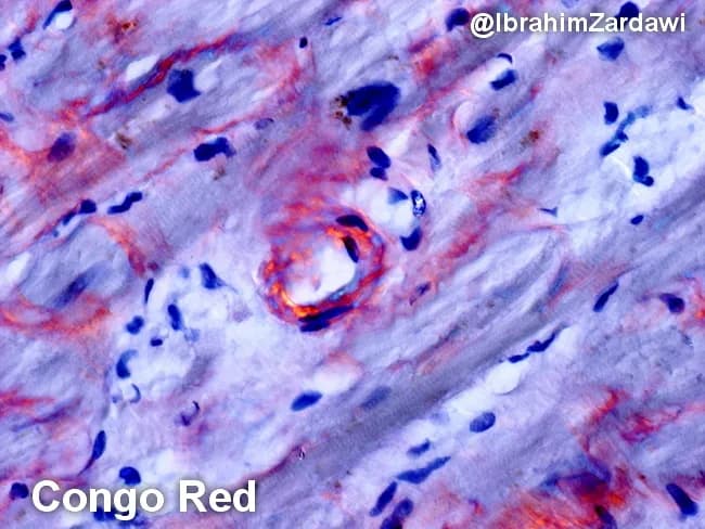 Imaging modality and technique: histopathology using light microscopy with Congo red staining of cardiac tissue, demonstrating characteristic amyloid deposition in the perimyocytic (pericellular) region of the myocardium. The deposited material appears orange to salmon pink on conventional hematoxylin-eosin–like chromogen, and exhibits classic apple-green birefringence under polarized light, confirming amyloid protein with a beta-pleated sheet configuration. The pattern is typically diffuse to pericellular around individual myocytes, producing a subtle, eosinophilic, amorphous coating that can obscure underlying cardiomyocyte detail. In this specimen, the amyloid is evident as an acellular, amorphous, hyaline-like material hugging muscle fibers, with irregular but cohesive contours and occasional nodular clusters. Congo red positivity combined with birefringence is diagnostic of systemic or cardiac amyloidosis when correlated with clinical data. Typing by immunohistochemistry, immunofluorescence, or mass spectrometry is often required to distinguish AL (light-chain) from ATTR (transthyretin) amyloidosis, which has implications for prognosis and treatment. Clinically, these deposits stiffen the myocardium, contributing to restrictive physiology and heart failure with preserved ejection fraction. The image illustrates foundational histopathologic criteria used in diagnosing cardiac amyloidosis and serves as educational material for pathology residents, cardiology fellows, and medical students studying protein misfolding diseases and Congo red histology. This image supports diagnostic confidence globally.