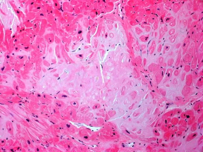 Histology of cardiac tissue demonstrating AL (light-chain) amyloid depositions with associated myocardial atrophy. Prepared as a hematoxylin and eosin stained section, viewed under bright-field microscopy, the myocardium shows extensive extracellular, eosinophilic, amorphous material within the interstitium surrounding relics of cardiac myocytes. The deposits are pale pink, homogeneous, and nonfibrillar by routine light microscopy, consistent with amyloid neuropathologic patterns and typical of AL amyloidosis. Cardiac myocytes exhibit variable atrophy with preserved nuclei in the interstitial milieu; there is sparse inflammatory infiltrate and disruption of normal architecture, contributing to stiff, diastolic-restrictive physiology. The diagnosis is supported by clinical context: a patient with multiple myeloma and lambda light chain clonal plasma cells, whose dyspnea reflects progressive restrictive cardiomyopathy due to myocardial amyloid infiltration. In histopathology terms, extracellular matrix expansion by amyloid coincides with deposition within vessel walls and perimysial spaces, potentially impairing coronary perfusion and contractile function. Clinically, this pattern signals poor prognosis if cardiac involvement is substantial, guiding oncologic therapy and cardiac supportive care. Differential considerations include transthyretin-type amyloid deposition and senile amyloidosis, but the light-chain profile and marrow findings make AL amyloidosis the favored etiology in this case. This slide illustrates characteristic cardiomyopathic changes with light-chain amyloid and myocyte attrition.