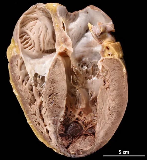 This gross pathology photograph documents an autopsy heart specimen with a longitudinal, apical view illustrating severe cardiovascular pathology underlying sudden death. Imaging modality: gross anatomy/necropsy photograph of a human heart, procured at autopsy, with a longitudinal/apical cross-section displaying the left ventricular apex. The heart exhibits marked biventricular hypertrophy with thickened LV walls and prominent endocardial surfaces. The anterior–apical septal region demonstrates features compatible with acute myocardial infarction, including pallor to dark discoloration and regional softening of myocardial tissue. A mural thrombus is evident at the LV apex, adherent to endocardial surface, presenting a risk for embolization. The coronary vasculature shows severe atherosclerotic narrowing in major epicardial vessels; although not visible in this specimen, the distribution is consistent with ischemic injury in the antero-apical-septal territory. The specimen is a postmortem evaluation, thus no in vivo contrast or staining was used. The scale bar indicates 5 cm for size reference. Clinical context includes obesity, diabetes mellitus type II, and tobacco use as major risk factors contributing to diffuse atherosclerosis and acute coronary occlusion. Diagnostic significance: confirms lethal ischemic heart disease with multivessel disease, supports sudden death due to acute MI with mural thrombus formation. Potential clinical applications include education, autopsy pathology reference, and radiology correlation.