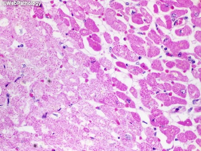 Imaging modality and tissue: light microscopy of hematoxylin and eosin stained myocardial tissue from the left ventricle showing acute infarct with myocytolysis. The left half of the field demonstrates pallor of necrotic cardiac myocytes, consistent with early ischemic injury about one day old. Disruption of the sarcolemma and loss of cytoplasmic integrity produce osmotic swelling as salt and water accumulate within myocytes, yielding pale, swollen, eosinophilic cells. Nuclei are pyknotic or obscured, and cross‑striations are variably preserved in some fibers while others show early coagulative necrosis. The surrounding myocardium exhibits preserved architecture with clear demarcation between infarcted and viable tissue. This stage precedes substantial neutrophilic infiltration and precedes macrophage clearance. The histologic features correlate with an acute coronary syndrome of short duration, typically anterior or lateral wall involvement depending on infarct territory, and predict ongoing impairment of contractility in the affected region. Clinically, this finding supports acute myocardial infarction (AMI) within 24 hours, ischemic necrosis, and myocytolysis as a pathologic correlate of severe ischemia. Differential considerations include early myocarditis, reperfusion injury, or artifact; however, the combination of pallor, sarcolemmal disruption, and myocytolysis most strongly supports early infarction. The image is diagnostic for early infarct with histologic confirmation.