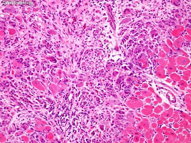 This histopathology image derives from cardiac muscle tissue subjected to light microscopy after hematoxylin and eosin staining. The section interrogates myocardial wall with preserved vascular framework showing dense inflammatory infiltration. The dominant cellular response comprises multinucleated giant cells intermixed with dense bands of lymphocytes, eosinophils, and histiocytes occupying the interstitium and peri-vascular spaces. Within the myocardium there is focal loss and fragmentation of myofibers, replaced by inflammatory cells and necrotic debris, a pattern compatible with myocarditis. The giant cells are derived from activated macrophages and are arranged in clusters adjacent to singleton foci of myocyte necrosis. Eosinophilic breakdown products and hemosiderin may be present in scattered macrophages. The tissue architecture shows patchy to confluent involvement of the ventricular myocardium, with occasional adipose tissue representing pericardial/epicardial infiltration at the margins. The image demonstrates a classic giant cell myocarditis phenotype—a rare, fulminant inflammatory cardiomyopathy associated with rapid heart failure and arrhythmias. The diagnostic significance lies in distinguishing giant cell myocarditis from lymphocytic myocarditis or granulomatous disease; findings guide immunosuppression and transplant considerations. This image is educational for cardiovascular pathology and graduate-level medical education, illustrating cellular diversity within myocarditis and the importance of multinucleated giant cells as a key diagnostic clue.