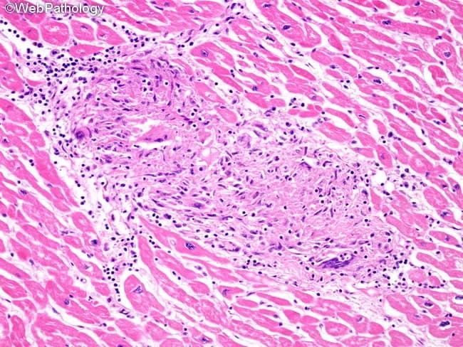Histology, light microscopy of cardiac tissue, reveals classic non-caseating granulomatous inflammation characteristic of cardiac sarcoidosis within the full thickness of the myocardium. The predominant architectural feature is well-demarcated granulomas composed of epithelioid histiocytes with multinucleated giant cells, embedded in a mononuclear lymphocytic infiltrate. Rare eosinophils may be present, but necrosis is minimal or absent. Granulomas are distributed along lymphatic channels and are frequently associated with the cardiac conduction system tracts, explaining potential electrical disturbances. The surrounding myocytes show preserved morphology with only focal interstitial fibrosis in many areas, reflecting chronicity and prior inflammatory injury. This histologic pattern differentiates sarcoid granulomas from other granulomatous myocarditis such as tuberculosis or hypersensitivity reactions, where caseation or different inflammatory profiles may occur. The tissue shows extensive lymphatic involvement and perivascular localization, contributing to impaired conduction and remodeling. The specimen, stained with Hematoxylin and Eosin, highlights the pink cytoplasm of myocardium and the dark nuclei of inflammatory cells, facilitating recognition of granulomatous foci, giant cells, and fibrotic change. Clinically, these findings support a diagnosis of cardiac sarcoidosis and carry implications for prognosis, arrhythmia risk, and indications for immunosuppressive therapy and device management. This description enhances searchability for cardiac pathology, granulomatous myocarditis, and sarcoid research applications.