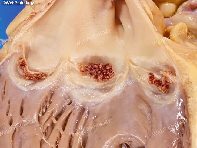 This is a gross pathology photograph of a heart specimen focusing on the right heart outflow tract and pulmonary valve region. The image demonstrates infective endocarditis with visible vegetations adherent to the pulmonic valve leaflets. Vegetations appear irregular, friable, and reddish-brown, measuring small to moderate size along the cusps; surface roughness and protrusions suggest valvular destruction risk. The pulmonary valve leaflets show nodular, irregular thickening with associated endocardial involvement; underlying cusp tissue may be eroded at the base. This right‑sided involvement is characteristic of intravenous drug use with Staphylococcus aureus bacteremia, and carries potential for septic emboli to the lungs. Associated findings may include mild dilation of the right ventricular outflow tract and adjacent endocardial surface. The image is an ex vivo photograph acquired under standard laboratory illumination; no histological staining or contrast enhancement was used. In clinical context, these gross features support a diagnosis of acute infective endocarditis of the pulmonary valve, with high risk of hemodynamic compromise if untreated. Differential considerations include nonbacterial thrombotic endocarditis and carcinoid valvulopathy, though friable infectious vegetations favor bacterial endocarditis. This finding underscores the need for urgent antimicrobial therapy and evaluation for surgical valve replacement in severe cases, especially with ongoing bacteremia.