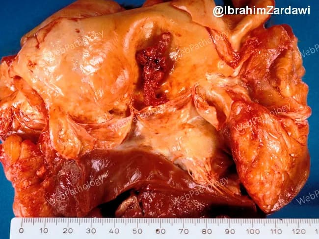 Gross photography of a surgically excised heart valve specimen showing a large, pedunculated vegetation attached to the non‑coronary cusp of the aortic valve. The lesion projects into the left ventricular outflow tract and measures several centimeters on the ruler included for scale. The vegetation has a polypoid, friable appearance with an irregular, lobulated surface and a tan-yellow to reddish hue consistent with fibrin, inflammatory debris, and possible microbial colonies not identifiable by gross inspection. The surrounding valve tissue is thickened and deformed, with partial leaflet destruction and altered commissural architecture. These macroscopic features are highly suggestive of an endocarditis-related vegetation, though definitive etiologic identification requires microbiologic culture and histopathology. The non-coronary cusp is the most involved site, with adjacent leaflet tissue showing edema and inflammatory changes. The image illustrates how infectious or inflammatory valvulopathy can disrupt valvular integrity, potentially leading to significant valvular insufficiency or outflow obstruction if not addressed surgically. Clinically, such a lesion prompts consideration of infective endocarditis (bacterial or fungal) or less likely nonbacterial thrombotic endocarditis, in the appropriate clinical setting. Correlation with echocardiography, blood cultures, and laboratory inflammatory markers is essential. This photograph serves as an educational example of valvular vegetation morphology and postoperative pathology. Teaching.