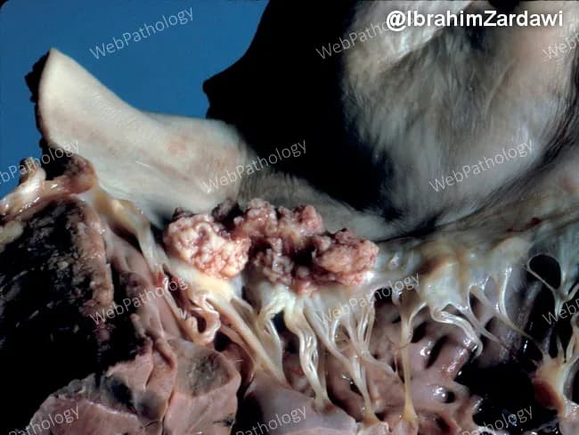 Gross pathology photograph of an explanted heart demonstrating left-sided infective endocarditis with mitral valve involvement. The image highlights a shaggy vegetative mass on the mitral valve, with thickened chordae tendineae and irregular nodularity of the cusp just to the right of the vegetation. The vegetations are friable and tan-pink, with adjacent valvular tissue showing edema and thickening. The chords appear markedly elongated and edematous, consistent with valvular destruction and tethering. The cusp shows focal thickening and rime-like nodules indicative of inflammatory deposition and possible microabscess formation. This gross morphology correlates with acute/subacute infective endocarditis, often due to bacterial pathogens such as Staphylococcus aureus or viridans streptococci, though fungal infections can also be implicated. Clinically, such findings signal bacteremia, embolic risk, and potential heart failure from valvular insufficiency. The image is valuable for education in cardiac pathology, surgical pathology, and infectious disease teaching; it demonstrates typical mitral valve vegetations, chordal involvement, and cusp irregularity useful for differential diagnosis with Libman-Sacks endocarditis, rheumatic disease, or marantic endocarditis. In practice, correlation with blood cultures, echocardiography, and systemic evaluation is essential for diagnosis and management. Documentation of vegetative morphology aids correlating radiographic and microbiological findings, informs prognosis, and guides rheology of therapeutic interventions management.
