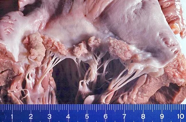 Gross pathology photograph of a heart valve with sterile, friable vegetations consistent with non-bacterial thrombotic endocarditis (NBTE, also called marantic endocarditis). The specimen shows the valvular leaflets and adjacent endocardium with pale, translucent to pinkish nodular thickenings along the lines of valve closure and on the atrial surface in this left-sided valve representation, most commonly the mitral valve. These vegetations are composed primarily of fibrin and platelets with little or no inflammatory cells and lack detectable organisms on routine assessment. The context of an advanced mucin-producing carcinoma—here endometrial carcinoma—supports a hypercoagulable state that predisposes to NBTE and embolic events. On gross inspection, the vegetations are usually small to moderate in size, friable, and may appear as irregular, spongy masses that can detach and embolize to the systemic circulation. The absence of vegetation-associated suppuration or ulceration helps distinguish NBTE from infectious endocarditis. Clinically, NBTE carries diagnostic significance by prompting evaluation for occult malignancy or systemic hypercoagulability, and management centers on anticoagulation rather than antibiotic therapy alone. This image underscores the macroscopic appearance used in pathology and cardiology to correlate echocardiographic findings with tissue-level pathology and to guide multidisciplinary care in oncology-associated thromboembolic syndromes.