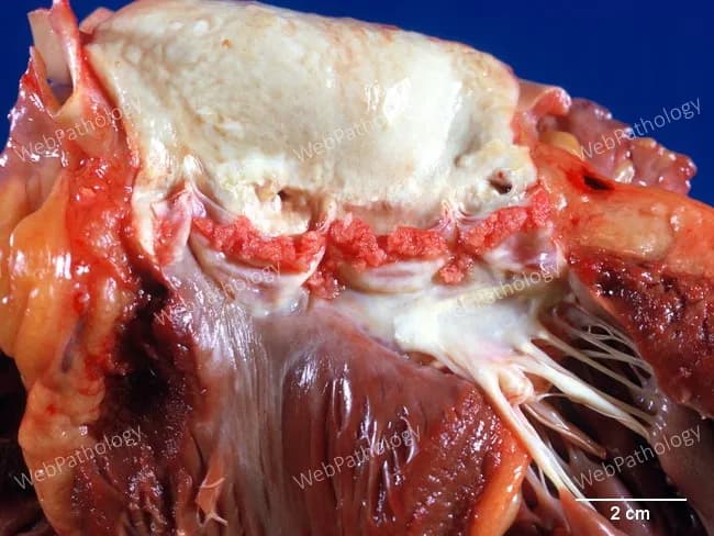 This is a gross pathology photograph of a dissected mammalian heart specimen, captured in a frontal, exterior view with key valvular and myocardial structures exposed. The scale bar indicates 2 cm for size reference. The specimen shows the left ventricular wall and base region, with overlying pale, chalky-appearing deposits along the atrioventricular junction and adjacent endocardial surfaces. Beneath the pale layer, the myocardium appears dark red to mahogany, with visible striations and a glossy texture consistent with fresh or lightly fixed muscle. Fine chordae tendineae and papillary muscle attachments extend toward the mitral valve apparatus, which is partially obscured by surrounding tissue. The epicardial fat is minimal, and surrounding cord-like connective tissue is evident in the valvular region. Overall, there is clear separation of tissue planes, allowing assessment of gross morphology without intact pericardium. Notable features include the juxtaposition of a dense, light-colored, non-vascular plaque-like region against vascularized myocardium, suggesting possible calcific or fibrous remodeling at the base of the heart. This image is suitable for educational demonstration of cardiac anatomy, valvular apparatus, gross pathologic appearance of myocardial tissue, and correlation with histopathology. Interpretation may guide differential considerations including fibrous valvulopathy, calcification, and sequelae of prior ischemic injury or remodeling.