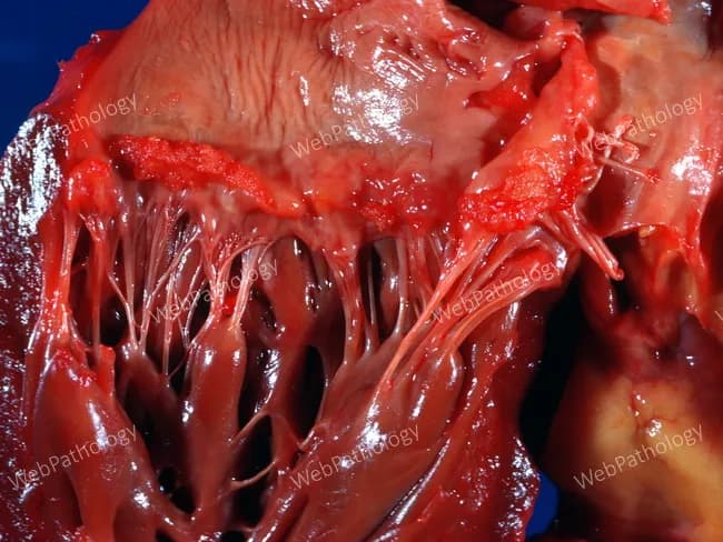 Gross macroscopic photograph of a resected lung parenchyma displaying extensive interstitial fibrosis with architectural distortion. The surface is densely red-brown and moist, with multiple translucent, web-like septa spanning alveolar spaces and creating irregular, honeycomb-like cystic spaces in subpleural regions. The parenchyma shows thickened alveolar walls and reticular remodeling throughout, most prominent in the bases and peripheries. There is vascular congestion and petechial hemorrhages in some areas; the pleural surface is partially adherent to fibrotic tissue. The underlying architecture demonstrates atelectasis and traction bronchiectasis in several lobes. The image reflects chronic fibrotic interstitial lung disease with end-stage features; however without histology correlation, the precise fibrosing phenotype is presumptive. This pattern aligns with idiopathic pulmonary fibrosis or other chronic fibrosing pneumonias, particularly those with a subpleural, basilar predominance. The gross features emphasize a restrictive physiology and reduced pulmonary compliance. Clinically, patients present with progressive dyspnea and nonproductive cough; radiology often shows reticular opacities, honeycombing, and architectural distortion on high-resolution CT. This specimen would be relevant for education in pulmonary pathology, interstitial lung disease differential, and surgical pathology workflows. It supports correlating clinical history, imaging, and histology to differentiate IPF from NSIP, hypersensitivity pneumonitis, and other fibrosing conditions. This description aids clinicians everywhere.