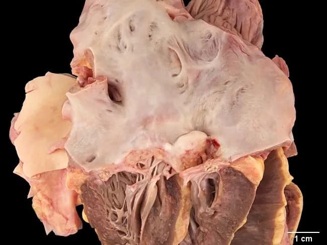 Gross pathology photograph of an excised mitral valve from a 55-year-old woman with long-standing systemic lupus erythematosus, illustrating Libman-Sacks endocarditis. The valve is stenotic with restricted leaflet mobility and marked left atrial dilation. Vascularized scar tissue is evident on the mitral leaflets near the line of closure, and the chordae tendineae are scarred and thickened. The surfaces exhibit irregular, pale to tan areas consistent with prior vegetations and repair, without visible bacterial organisms. The specimen demonstrates sterile vegetations and fibrinous thrombi embedded with immune complexes and mononuclear cells—hallmarks of nonbacterial thrombotic endocarditis in autoimmune disease. These changes produce impaired valvular function, typically mitral stenosis with or without regurgitation, and contribute to chronic left atrial enlargement. Clinically, Libman-Sacks endocarditis indicates active systemic lupus erythematosus with cardiac involvement and may increase risk of embolization and heart failure. The image supports the differential diagnosis against infectious endocarditis, rheumatic valvulitis, and marantic endocarditis, emphasizing autoimmune valvulopathy. This gross finding correlates with histopathology showing sterile vegetations; echocardiography often complements diagnosis in vivo. The case underscores the importance of multidisciplinary management combining immunosuppression and, when needed, valvular intervention. This image is suitable for educational, surgical planning, and pathophysiology research contexts and supports standardized reporting and citation.