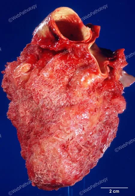 This gross pathology image depicts the heart with the visceral pericardial surface coated by a dry, coarse granular exudate consistent with fibrinous pericarditis following myocardial infarction. The pericardial surface is roughened and opaque, lacking a serous effusion, and the fibrinous layer appears adherent at several foci, giving a bread-and-butter texture in places. The scale bar indicates 2 cm for size reference. The underlying myocardium is not fully visible but the inflammation is localized to the pericardial layers, a common early complication after acute infarction. Macroscopically, fibrin strands produce a granular, filamentous appearance with a friable, waxy consistency. This lesion reflects an acute inflammatory process secondary to myocardial necrosis, with fibrin deposition along the epicardial and parietal pericardial surfaces. Clinically, fibrinous pericarditis after MI presents with chest pain and a friction rub, and may progress to adhesions and effusion if unresolved. This image is valuable for teaching post-infarction complications, correlating gross pathology with histology of fibrinous exudate, and illustrating differential diagnoses such as serofibrinous or purulent pericarditis. It also supports educational use in pathology libraries, medical education, and case-based learning for cardiology and internal medicine. This representation reinforces recognition of postinfarction fibrinous pericarditis patterns in exams and clinical review materials worldwide.