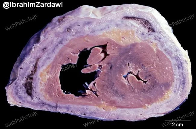 Gross pathology specimen illustrating chronic constrictive pericarditis. Modality: gross pathological examination of a fixed cardiac specimen. Technique: transverse cross-section through the pericardial sac surrounding the ventricles; surrounding mediastinal fat is variably reduced. Notable features: markedly thickened, fibrotic pericardium with calcific rim encasing an incompletely compliant heart. Visceral and parietal pericardial layers are adherent; the pericardial cavity is reduced or obliterated in several regions. The epicardial surface may show mild inflammatory change with preserved myocardial architecture. The myocardium itself demonstrates normal color and architecture but appears constrained by the stiff envelope, with limited diastolic excursion simulated by manual manipulation. Calcific nodules along the pericardial leaflets give a gritty texture on palpation. Collectively, these findings reflect the pathophysiology of constrictive physiology: restricted ventricular filling, reduced stroke volume, and equalization of diastolic pressures. The macroscopic diagnosis is constrictive pericarditis with calcification, often secondary to chronic inflammation from infection (tuberculosis), prior cardiac surgery, or idiopathic causes. Clinically, pericardiectomy removing both visceral and parietal layers is the definitive treatment. The image corroborates surgical planning by demonstrating the extent and distribution of calcification and dense fibrous tissue. Noninvasive imaging (echocardiography, CT, MRI) provides complementary assessment of hemodynamics and pericardial thickness.