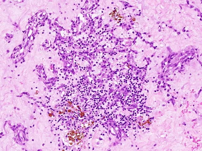 This case depicts a hematoxylin-eosin stained histologic section of a cardiac myxoma, displaying a prominent myxoid stroma rich in mucopolysaccharide matrix with scattered tumor cells. The cellular component comprises small, oval to stellate myxoma cells arranged in intricate, cribriform or arborizing patterns around vascular channels, a morphology that can mimic metastatic carcinoma when arranged in pseudo-glandular architectures. Background shows chronic inflammatory cells and hemosiderin-laden macrophages within the loose myxoid matrix, consistent with prior microhemorrhage or prior inflammation. The tissue architecture ranges from loose, hyaline-like regions to more cellular whorled areas, underscoring the heterogeneity of myxoid tumors. Diagnostic significance lies in recognizing classic myxoma features—mucinous stroma, sparsely distributed cells, and vessel-adjacent patterns—to distinguish from carcinomatous metastases and other myxoid neoplasms. Differential diagnoses include metastatic adenocarcinoma, myxoid liposarcoma, angiosarcoma, and fibromyxoid sarcomas. Clinically, this histology should be integrated with cardiac imaging findings (echocardiography, cardiac MRI) to confirm mass origin in the heart; surgical excision is typically curative, and pathologic assessment must assess margins and exclude metastasis. The cribriform and arborizing patterns around vascular channels are focal; overall architecture remains myxoid. Immunohistochemistry, when performed, shows positivity for vimentin and negativity for cytokeratins, aiding distinction from metastatic carcinomas. This image serves as an instructive reference for pathology education and multidisciplinary tumor-board correlation.