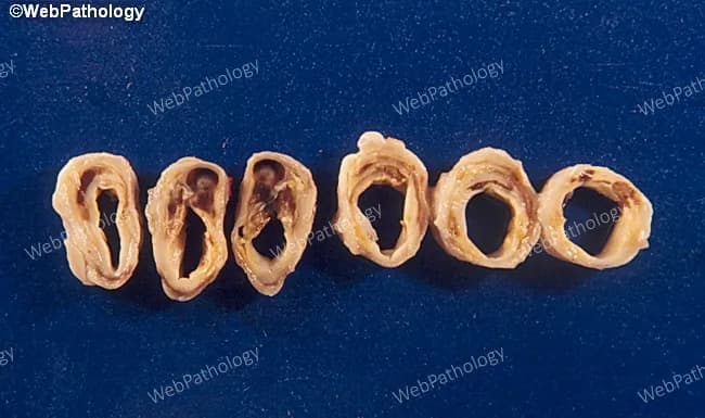 Gross pathology photograph of human coronary arteries showing atherosclerotic plaques with intraplaque hemorrhage in the right coronary artery. The image presents multiple arterial segments with circumferential intimal thickening and lipid-rich atheromatous deposits producing luminal narrowing. In the second and third sections from the left, hemorrhagic material is evident within the plaque core, indicating intraplaque hemorrhage, a key destabilizing event in acute coronary syndromes. The plaques appear fibrofatty with irregular, disrupted fibrous caps, consistent with a high-risk lesion prone to rupture and superimposed thrombosis. The anatomy depicted reflects advanced coronary atherosclerosis in an adult female; such lesions commonly precede unstable angina, acute myocardial infarction, or sudden cardiac death following plaque rupture, erosion, fissuring, or hemorrhage. From a pathological standpoint, these gross findings illustrate the pathophysiology of myocardial ischemia: occlusive thrombosis over a vulnerable plaque leading to cessation of distal blood flow. Clinically, intraplaque hemorrhage accelerates plaque expansion by increasing lipid core size and reducing cap thickness. The image is valuable for education on plaque morphology, identifies mechanisms of ACS, and supports differential considerations including plaque rupture, thrombosis, erosion, and hemorrhagic transformation. Overall, this photograph emphasizes the importance of plaque stability in cardiovascular risk assessment and autopsy analyses. Educational and research contexts.