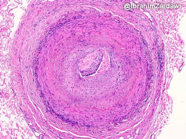 This histology image captures a cross-sectional temporal artery biopsy illustrating the hallmarks of giant cell arteritis. Prepared as a paraffin-embedded tissue section and stained with Hematoxylin and Eosin, the slide reveals a transmural inflammatory infiltrate that traverses all arterial wall layers. At the center, a narrowed lumen is surrounded by concentric intimal hyperplasia with marked medial disruption. Multinucleated giant cells and mononuclear macrophage clusters are present within the media, accompanied by lymphocytic infiltrate along the vessel wall. The elastic lamina appears disrupted, and fragmentation of the media is evident, consistent with robust granulomatous vasculitis. These features produce near-occlusive narrowing of the artery, explaining the ischemic risk associated with temporal arteritis. Clinically, such histopathology confirms a diagnosis of GCA and helps differentiate from atherosclerotic disease, infectious vasculitis, or other large-vessel vasculitides. The image underscores the systemic nature of the disease, as inflammation can extend from cranial vessels to the aorta. The diagnostic significance lies in correlating histology with patient presentation, including age-related cranial symptoms and risk of vision loss; timely immunosuppressive therapy can prevent irreversible ischemic complications. This specimen exemplifies classic angiitis with granulomatous inflammation and intimal hyperplasia driving luminal compromise.