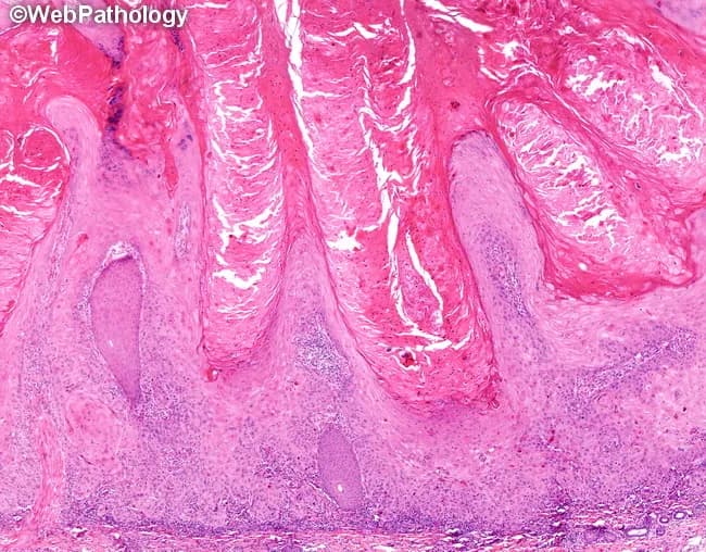 Light microscopy of a skin biopsy stained with Hematoxylin and Eosin reveals crateriform epidermal proliferation consisting of well-differentiated keratinizing squamous epithelium with eosinophilic ground-glass cytoplasm. Central keratinization forms a keratin plug, surrounded by an abrupt epithelial crater. Microabscesses with neutrophils are commonly present, and a mixed inflammatory infiltrate including eosinophils may accompany deeper tissue involvement. The tumor typically displays pushing margins with little true infiltration into adjacent dermis; however, rare cases show invasion into underlying skeletal muscle, and infrequent perineural or vascular invasion. Deeper aspects may show cellular maturation toward the surface, while the basement membrane remains relatively intact in noninvasive areas. When involution occurs, the keratin plug is lost, the epithelial proliferation diminishes markedly, and the lesion floor flattens. Chronic inflammation and fibrosis with a foreign body giant cell reaction to released keratin are characteristic of the involutional phase. Nuclear atypia is typically absent, though some instances may exhibit mild pleomorphism, necrosis, or mitotic activity restricted to basal layers. The overall pattern - crateriform architecture, abrupt keratinization, and a brisk inflammatory milieu with keratin debris - helps distinguish this entity from conventional squamous cell carcinoma. Clinically, keratoacanthoma often presents as a rapidly growing skin nodule and may spontaneously regress, informing management decisions and differential diagnoses.