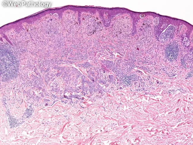 A histopathologic skin biopsy evaluated by light microscopy following routine hematoxylin and eosin (H&E) staining. The specimen is an excisional biopsy of cutaneous tissue. The image shows malignant melanocytic proliferation with invasion through the epidermal-dermal junction into the dermis. Tumor nests and single-cell invasion are evident at the dermoepidermal junction with dermal penetration by pigmented melanocytes. Breslow thickness, the most important prognostic parameter in melanoma, is measured from the most superficial granular cell layer of the epidermis to the deepest point of tumor invasion; in this case the depth is 1.0 millimeter. If an ulceration is present, depth is measured from the base of the ulcer; ulceration is not described here. Some tumors may extend along adnexal structures, and if present this finding is documented as part of depth assessment. Polypoid tumor components, if any, are measured through their thickest region. Although invasion depth is continuous, AJCC guidelines categorize 1 mm, 2 mm, and 4 mm for staging (T1, T2, T3). Clinically, Breslow depth informs prognosis, sentinel lymph node biopsy decisions, and surgical margins for wide local excision, as well as consideration for adjuvant therapy depending on ulceration, mitotic rate, and nodal status.