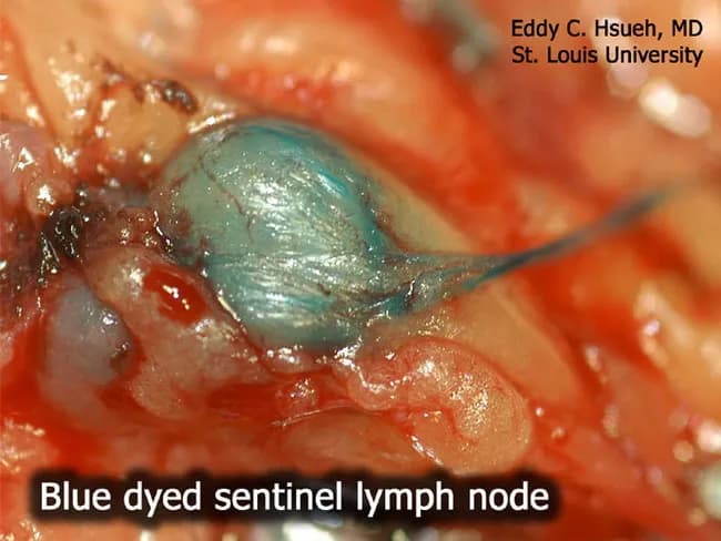Imaging modality: Intraoperative surgical photography of a sentinel lymph node biopsy for malignant melanoma. Technique: blue dye mapping using Lymphazurin blue (isosulfan blue) injected near the primary lesion to trace afferent lymphatics to the sentinel node, which is visually stained a blue-green hue. Anatomical context: axillary regional lymphatics draining the tumor bed are highlighted by dye transport, with the sentinel lymph node identified by conspicuous color uptake. Visual features: a single lymph node is enlarged and engorged, with surrounding adipose tissue and operating field in clear view; the node exhibits uniform blue coloration within the cortex and hilum, with surrounding soft tissues appearing erythematous from operative exposure. Notable findings: blue-stained sentinel node ready for targeted excision; no gross metastatic nodal disease is discernible on this view, though microscopic metastasis may be present. Clinical significance: sentinel lymph node biopsy is a standard staging procedure in melanoma, enabling nodal assessment while minimizing extensive lymphadenectomy. Differential considerations: accidental intradermal staining, dye leakage, or allergic reaction to isosulfan blue. Clinical correlation: histopathologic examination of the excised node is required to determine nodal metastasis status, guiding adjuvant therapy and prognosis. This image serves educational and surgical planning purposes for clinicians, trainees, and researchers studying lymphatic mapping in cutaneous melanoma.