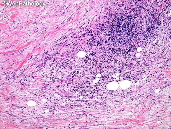 This histopathology slide represents a tissue biopsy examined under light microscopy following Hematoxylin and Eosin staining. The specimen displays dense fibrous stroma with scattered inflammatory cells and well-formed granulomatous nodules. Within the nodules, aggregates of epithelioid macrophages form tightly packed, elongated cells with eosinophilic cytoplasm. Occasional multinucleated giant cells, likely of Langhans-type, are present at the granuloma periphery. A surrounding cuff of small lymphocytes and plasma cells is evident, reflecting chronic inflammatory activity. The background shows mild edema and preserved tissue architecture in adjacent areas. There is no definitive, confluent caseous necrosis in this field, though processing artifacts can obscure subtle features. Overall, the image depicts granulomatous inflammation of uncertain etiology, requiring correlation with clinical data and ancillary studies. Diagnostic significance lies in identifying granulomas as a non-specific inflammatory pattern that prompts targeted infectious and non-infectious workups. Differential considerations include sarcoidosis (noncaseating granulomas), mycobacterial or fungal infections, foreign body reaction, and granulomatous dermatitis. This image is educational for histopathology training, pathology workflow, differential diagnosis formulation, and integration with radiologic or clinical findings to guide further testing and management decisions. Clinicians may use this pattern to decide requests for special stains, cultures, and targeted imaging and therapeutic plans thereafter.