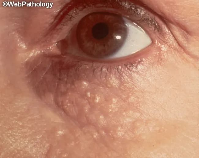 Clinical photography of the periorbital skin demonstrates multiple small, firm, yellow to skin‑colored papules clustered around the eyelids. Each lesion measures approximately 1–3 mm in diameter and lacks ulceration or crusting. The distribution is predominantly periorbital, with preference for the periorbital eyelid skin and adjacent malar area, consistent with syringomas—benign eccrine sweat duct tumors. The image emphasizes a tangential, close‑up view suitable for surface dermatology assessment, with good color fidelity to reveal the characteristic papule texture. In this condition, lesions represent benign proliferations of eccrine ducts within the dermis and are non-inflammatory, usually asymptomatic, though they may be cosmetically distressing. Differential diagnosis includes milia, xanthelasma, sebaceous hyperplasia, and other adnexal tumors; however, syringomas typically present as small, skin‑colored or yellow papules in clusters around the eyelids, whereas milia are white and more superficial. The clinical significance lies in distinguishing benign syringomas from other eyelid lesions to guide management, which is often cosmetic (laser ablation, electrodessication, or topical therapies) rather than urgent. This image is valuable for dermatology and pathology education, clinic photo atlases, and differential diagnosis training in eyelid lesions and periorbital dermatology. Correlates with onset in adolescence or early adulthood and a female predilection; may accompany genetic syndromes in rare cases.