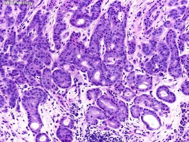 Comprehensive description: Histopathology micrograph of breast lesion showing apocrine carcinoma with glandular differentiation. The specimen is a formalin-fixed, paraffin-embedded tissue section stained with Hematoxylin and Eosin and viewed under bright-field illumination at high magnification (approximately 400× total). Tumor cells are arranged in cohesive nests and small ducts with occasional cribriform and acinar patterns, reflecting glandular differentiation. The epithelial cells exhibit abundant eosinophilic, granular cytoplasm and large, round to ovoid nuclei with conspicuous nucleoli. Apical decapitation secretions are evident on the top-middle aspect of the field, a characteristic feature of apocrine differentiation. Mitoses are variable and nuclear atypia ranges from mild to marked, with occasional prominent nucleoli and intraluminal secretions. The surrounding stroma shows a desmoplastic reaction in places, with occasional inflammatory infiltrate. No definite necrosis or lymphovascular invasion is clearly visible in this field, though assessment requires full sections. Immunohistochemical profiling is typically pursued to confirm apocrine differentiation and receptor status (ER/PR negative, AR positive; HER2 varied). This image is relevant for diagnostic education, differential diagnosis (apocrine carcinoma vs. ductal carcinoma with apocrine features), and radiology-pathology correlation in breast pathology, surgical pathology teaching, and histology training. This description supports searchability for education, research, and clinical workflow optimization in pathology practice.
