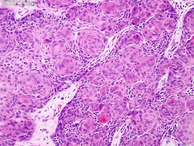 This is a high-fidelity light microscopy image of a formalin-fixed, paraffin-embedded skin biopsy stained with Hematoxylin and Eosin, viewed under bright-field illumination at 400x total magnification (40x objective). The epidermal squamous cells show cohesive nests and finger-like islands with pronounced keratinization. The most striking feature is a striking whorling pattern composed of concentric lamellations of epithelial cells, forming keratin pearls in a well-differentiated squamous phenotype. The cells are polygonal with abundant eosinophilic cytoplasm, distinct intercellular bridges, and prominent, often irregular nuclei with mild-to-moderate atypia. Mitotic figures are present in some areas, but the overall architecture demonstrates orderly differentiation with lamellated keratin deposition. The surrounding dermis exhibits a mild inflammatory infiltrate and scattered fibrovascular stroma, with no obvious overt invasion in this field; however, invasion may be present in deeper sections. Pathologic interpretation centers on squamous differentiation with keratinization; keratin pearls and whorling patterns support a squamous lineage and are characteristic of well-differentiated squamous cell carcinoma or keratoacanthoma depending on context. Clinically, this histology informs diagnostic considerations, helps distinguish from basal cell carcinoma and benign hyperkeratosis, and guides management decisions such as surgical excision with clear margins and staging assessment. Correlation with clinical history and ancillary studies improves accuracy and prognostication.