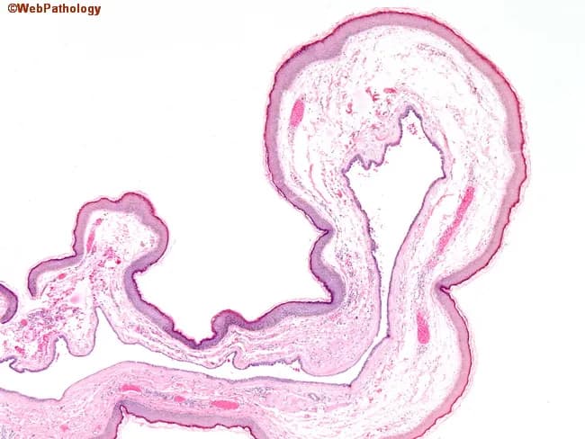 This histopathology image depicts a paraffin-embedded small intestinal mucosa section stained with Hematoxylin and Eosin (H&E), captured at a low-to-mid magnification to emphasize overall villous architecture. The tissue shows finger-like villi emanating from the lamina propria, with closely apposed, tall mucosal folds consistent with villous mucosa of the small intestine. The surface epithelium appears as simple columnar enterocytes with scattered goblet cells, and the absorptive cell brush border is not resolved at this scale. The lamina propria contains loose connective tissue with a sparse vascular network, and the muscularis mucosae is present as a thin boundary beneath the mucosal layer. No overt architectural distortion, crypt branching, or dysplastic glands are evident in the visible fields; there is no clear inflammatory infiltrate or edema highlighted at this magnification. The image emphasizes normal or near-normal mucosal pattern, suitable as a baseline reference for comparison with samples showing villous atrophy, blunting, or neoplastic villiform growth. This slide is relevant for routine evaluation of malabsorption syndromes, celiac disease workups, polyps with villous features, or educational demonstrations of normal intestinal histology. Accurate interpretation requires correlating endoscopy findings, patient history, and additional sections to differentiate normal variants from pathology.