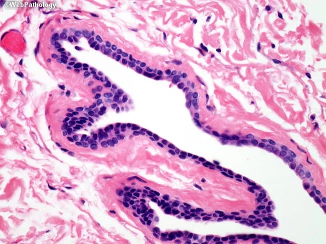 This histology slide is stained with Hematoxylin and Eosin and viewed under light microscopy. It shows branching tubular glands embedded in loose eosinophilic connective tissue stroma. The glands exhibit a well-organized epithelial lining consisting of tall columnar to cuboidal cells with basally oriented nuclei and scant cytoplasm. Lumina are variable in size and shape, ranging from rounded to elongated, with occasional pale secretory material within the lumen. The epithelial cells display minimal cytologic atypia, occasional small nuclear crowding, and no evident mitotic activity in this field. The surrounding stroma is pink and fibrous, with sparse inflammatory cells and few myofibroblasts. Overall architectural pattern is compatible with benign glandular epithelium or non-neoplastic glandular proliferation; differential considerations include normal mucosal glands, simple hyperplasia, or benign adenoma. There is no clear evidence of invasion into the adjacent stroma within the imaged section. This image is valuable for educational purposes in histology and diagnostic pathology, illustrating glandular morphology, lumen formation, epithelial-stromal relationships, and the spectrum between benign and neoplastic glandular processes. It supports teaching of ductal anatomy, tissue architecture, and histopathologic correlation with clinical scenarios. Clinically relevant context includes post-surgical specimens and mapping of glandular margins. This supports comparative pathology training and exam preparation.