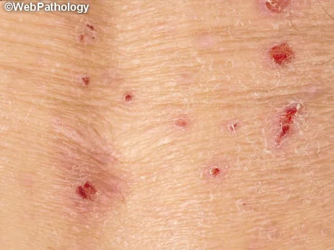 Clinical photography of the skin illustrating dermatitis herpetiformis, an intensely pruritic, grouped vesiculopapular eruption associated with gluten-sensitive enteropathy. The image demonstrates widespread, symmetrical involvement of extensor surfaces including elbows and knees, with additional lesions on the buttocks, scapular region, and sacral area; facial or scalp involvement may occur. Lesions begin as erythematous papules that rapidly evolve into firm-topped vesicles or urticarial plaques, frequently excoriated to crusts from persistent scratching. The clustered distribution and pruritus are characteristic; bullae may be present in advanced plaques. On a clinical basis, dermatitis herpetiformis correlates with underlying celiac disease and an immune response to dietary gluten. Histology (when biopsied) reveals neutrophilic microabscesses at the tips of dermal papillae with superficial dermal neutrophilic and eosinophilic infiltrates. Direct immunofluorescence classically shows granular IgA deposition at dermal papillae with accompanying C3 and sometimes C5 components. Management includes dapsone for rapid symptom control and a strict gluten-free diet to address the enteropathy. The image is a dermatology photograph suitable for educational purposes, differential diagnosis discussions, and radiology-free teaching; it can be used to illustrate skin manifestations that predate or accompany GI symptoms and to emphasize multidisciplinary care. Close clinical correlation with serology and biopsy improves diagnostic confidence in practice.