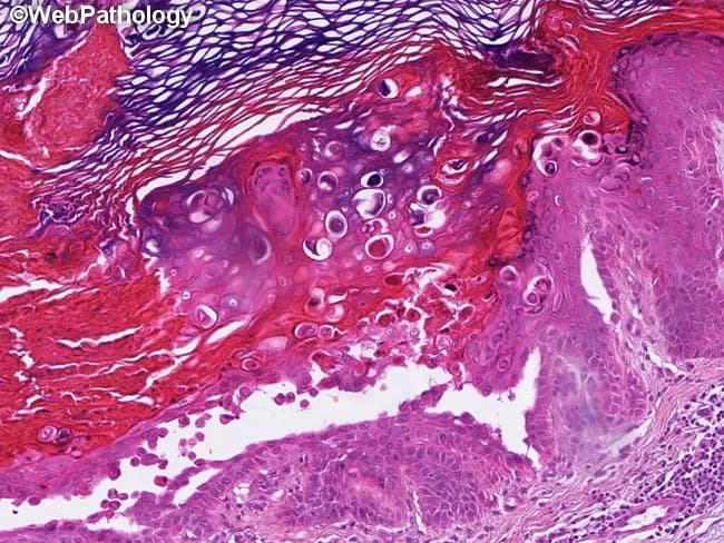 Histopathology slide of a cutaneous lesion stained with Hematoxylin and Eosin (H&E) under light microscopy, depicting classic Darier disease features. The epidermis shows marked hyperkeratosis with irregular, papillated acanthosis and prominent suprabasal clefting due to focal autoimmune-like detachment of squamous cells. Within the spinous and granular layers, numerous dyskeratotic cells are present, including the hallmark corps ronds (round, eosinophilic dyskeratotic cells with pyknotic nuclei) and grains (smaller, flattened dyskeratotic cells) situated near the keratin layer. The basal layer remains relatively preserved, whereas keratinocyte cohesion is variably disrupted. The dermis displays a mild, mixed inflammatory infiltrate without overt dermal necrosis. The composite histology—hyperkeratosis, acantholysis with suprabasal clefts, and dyskeratosis with corps ronds and grains—is highly characteristic for keratosis follicularis (Darier disease), and closely correlates with ATP2A2 gene mutations. Clinically, these findings support a diagnosis in patients with seborrheic-like papules and nail/ mucocutaneous involvement. Differential considerations include Hailey-Hailey disease (acantholysis without prominent corps ronds or grains) and Grover disease, though the dyskeratotic patterns are distinguishing. Overall, histologic pattern recognition aids diagnostic confirmation, genetic counseling, and therapeutic planning, including retinoid-based strategies and monitoring of disease progression in dermatology practice and educational settings. This image exemplifies canonical diagnostic criteria for educational and clinical use.