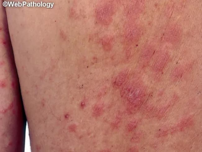 Clinical photography of a generalized morbilliform drug eruption on the skin illustrating an exanthematous eruption due to fosinopril, an ACE inhibitor prescribed for hypertension. The image depicts numerous erythematous macules and papules, some coalescing into diffuse patches on the trunk and proximal limbs, including the exposed upper arm. Lesions are blanching on pressure, non-vesicular, slightly raised, and pruritic in many patients. There is no mucosal involvement evident in this view. Morphology is stereotypical for a morbilliform eruption: symmetric distribution, rapid onset after drug exposure, and a proximal-to-distal spread pattern. The clinical context supports a cutaneous adverse drug reaction triggered by fosinopril, with timing typically 5–14 days after initiation or dose escalation, consistent with a type IV hypersensitivity mechanism. Diagnostic significance lies in recognizing drug-induced exanthem to prevent progression, guide drug withdrawal, and prompt substitution with an alternative antihypertensive (e.g., an ARB). Differential diagnoses include viral exanthem, allergic contact dermatitis, and pityriasis rosea; clinical correlation with medication history is essential. If biopsy is performed, histology would commonly show superficial perivascular lymphocytic infiltrate with eosinophils and mild spongiosis. This image is useful for clinical education, pharmacovigilance, and dermatology training on ACE inhibitor–related rashes and drug eruption management. Prompt action improves patient outcomes.