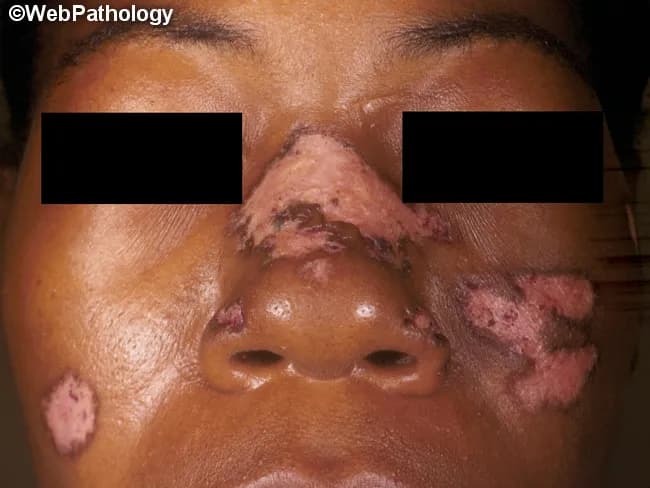 Clinical photography of facial skin illustrating discoid lupus erythematosus (DLE) with sun-exposed-area involvement. Frontal/anterior view of the face shows multiple erythromatous plaques on the cheeks, nasal bridge, perioral region, and ears, with overlying adherent scales and peripheral erythema. Lesions are firm and may exceed several centimeters; keratin plugs are often evident beneath scales when removed. Chronic plaques exhibit atrophic scarring and pigmentary alteration, including hypopigmentation in darker skin tones; depigmentation can be disfiguring and scalp involvement suggests long-standing, severe disease. Early lesions may be erythematous and edematous before plaque formation. The distribution pattern is predominantly head and neck in localized DLE but can extend to non-exposed sites in generalized disease; photosensitivity with seasonal exacerbations in spring/summer is typical. Clinically, the appearance—well-demarcated, scale-covered plaques on sun-exposed skin—helps distinguish DLE from seborrheic dermatitis, rosacea, and actinic damage; differential includes lupus erythematosus profundus, psoriasis, and granulomatous diseases. The image underscores the importance of sun protection, topical corticosteroids or calcineurin inhibitors, and potential antimalarial therapy in management. This photographic reference is valuable for dermatology education, augmenting recognition of cutaneous lupus manifestations, scarring alopecia risk, and the need for biopsy confirmation when systemic involvement is uncertain. Images like this support diagnostic training and patient counseling in lupus care.