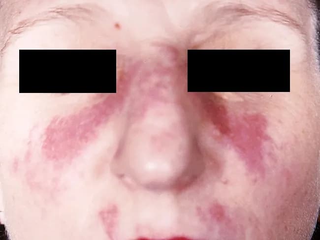 This clinical dermatology photograph displays the classic malar or butterfly rash of systemic lupus erythematosus (SLE) on the central face. Modality is clinical photography using standard white-light illumination; frontal/anterior view; color-balanced, high-resolution capture to depict superficial erythema and patchy hyperemia across the malar eminences and nasal bridge. The rash forms a bilateral, 'butterfly' distribution that typically reaches the cheeks and bridge of the nose while sparing the nasolabial folds. The observed features include confluent to patchy, erythematous macules and plaques with uniform erythema, mild perivascular edema, and subtle textural change without overt crusting or scaling in this image. The clinical morphology is characteristic for acute cutaneous lupus erythematosus; photosensitivity may exacerbate lesions. This cutaneous finding is one of the diagnostic criteria for SLE when aligned with serologic abnormalities (ANA, anti-dsDNA) and systemic features; its presence increases diagnostic probability in a compatible patient. Differential considerations include rosacea, seborrheic dermatitis, contact dermatitis, and dermatomyositis rash; however, the malar distribution and nasal bridge involvement help distinguish lupus. Clinically, this image supports SLE workup and educational reference for recognizing lupus-associated facial rash in medical students, residents, and researchers; useful for pattern-recognition training and multimodal data repository indexing. This image emphasizes clinical-context interpretation and education.