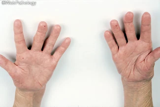 Clinical photography of both hands in dorsal view illustrating cutaneous manifestations of CREST syndrome, a limited form of systemic sclerosis. The image captures distal involvement with sclerodactyly characterized by sausage-like, firm fingers and tightly stretched skin. Telangiectatic vascular ectasia is evident on the dorsum of the hands and at digit tips, with occasional perioral telangiectasia suggested by subtle surface vessels near the lips. The skin appears pink-red and slightly glossy, reflecting chronic tightening and reduced pliability. In this presentation, Raynaud's phenomenon and calcinosis are common associated features though not directly visible in this photograph. Esophageal dysmotility, a hallmark of CREST, is clinically relevant but not demonstrable in an image; nonetheless, the clinical context remains important. The photographic field emphasizes distal-to-MCP joint distribution and the relative sparing of proximal extremities, which is typical for limited cutaneous disease. This image can be used for educational purposes to illustrate hallmark signs: scleroderma-like skin thickening, digit shortening, and superficial vascular changes without ulceration. Potential clinical applications include dermatologic assessment, rheumatology referral decision, patient education on disease phenotype, and documentation of progression or response to therapy aimed at vascular symptoms, skin tightening, and gastrointestinal involvement.