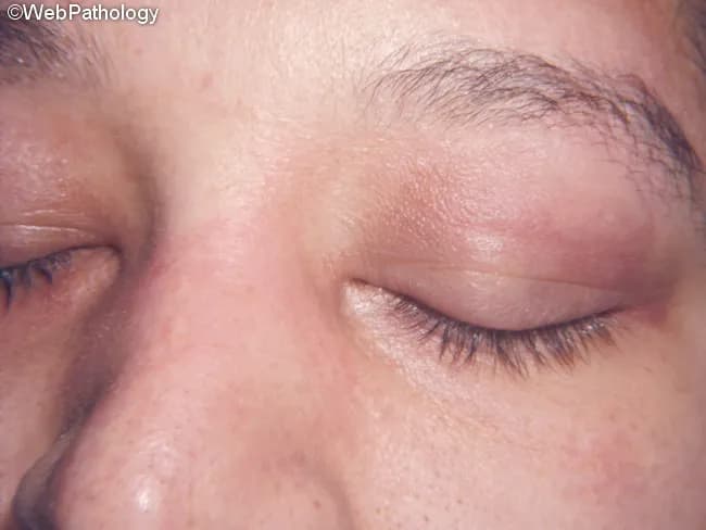 Clinical photography in dermatology showing a classic heliotrope rash: violaceous to reddish-violet edema surrounding the periocular region, most prominent on the upper eyelids. The periorbital erythema is symmetric in many cases and may extend onto the cheeks. This image highlights the heliotrope sign characteristic of dermatomyositis, a cutaneous/subcutaneous inflammatory myopathy. The skin texture appears slightly smooth with subtle flattening of the eyelid creases and mild edema. While the watermark indicates WebPathology, the essential diagnostic feature is the periorbital purple discoloration with edema rather than primary mucocutaneous ulcers or vesiculation. The lesion distribution often includes the neck, upper trunk (shawl sign), extensor surfaces of the limbs, and dorsal aspects of hands and fingers. Recognition of this finding should prompt evaluation for proximal muscle weakness, elevated muscle enzymes, myositis-specific antibodies, and risk stratification for interstitial lung disease and associated malignancy in adults. Differential diagnoses include eczema, allergic contact dermatitis, rosacea, and lupus malar rash, but the heliotrope coloration with edema is highly suggestive of DM. This image is valuable for clinical education, aiding clinicians, residents, and students in distinguishing DM cutaneous signs from non-specific dermatitis and in correlating skin findings with potential muscle involvement and systemic disease.