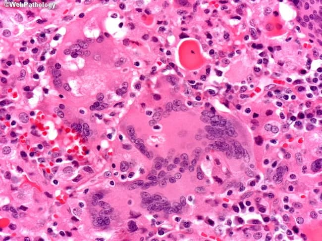 High-magnification bright-field histology of thyroid gland tissue stained with Hematoxylin and Eosin (H&E). The specimen shows granulomatous inflammation characterized by numerous foreign body giant cells and aggregates of epithelioid histiocytes embedded in a pink cytoplasm background. The thyroid parenchyma is variably disrupted with scattered lymphocytes and plasma cells; there is no well-formed granuloma rim, and there is no focal caseous necrosis evident. Multinucleated giant cells frequently contain cholesterol-rich debris and refractile material consistent with a foreign body reaction. The microarchitecture lacks overt cytologic atypia and no malignant cells are seen. Follicular colloid appears diminished in areas of inflammation. These features are compatible with granulomatous thyroiditis, most consistent with subacute (de Quervain-like) thyroiditis, but the absence of caseation argues against tuberculous thyroiditis. The image highlights the distinction between inflammatory thyroid disease and infectious etiologies. Clinically, such histology correlates with tender thyroid, transient thyrotoxic phase followed by hypothyroidism in some cases, elevated ESR, and leukocytic infiltration. Differential diagnoses include sarcoid thyroiditis and TB, which would show caseating granulomas or granulomatous inflammation with caseation. This high-magnification view is valuable for educational purposes and for correlating histology with endocrine pathology. Clinicians should correlate clinically with serology and imaging. Useful for teaching and research.
