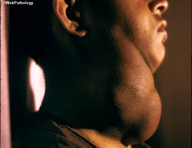 This image is a gross pathology photograph of the anterior neck demonstrating marked thyroid enlargement consistent with nodular hyperplasia (multinodular goiter). Acquired from a lateral profile view, the external contour shows a diffuse, enlarged thyroid gland occupying the lower neck with conspicuous nodularity and prominence of the isthmus. The patient is clinically euthyroid, a common feature of nodular goiter, with thyroid hormone levels typically within normal range despite substantial gland enlargement. Endemic forms in iodine-deficient regions result from chronic stimulation by elevated TSH, leading to hyperplastic nodules that create mass effect. The goiter here is sufficiently large to cause disfigurement, and in advanced cases may impinge on the trachea, producing potential airway compromise. Grossly, the thyroid tissue demonstrates uneven surface topology that may correspond to coarse nodularity; internal histology would typically reveal variably-sized follicles with fibrous septa and colloid depletion depending on the nodule. Clinically, this condition is distinguished from solitary adenomas and thyroid carcinomas by its multinodular architecture, diffuse enlargement, and euthyroid state. Diagnostic significance lies in recognizing goiter-related airway compression risk, cosmetic deformity, and iodine deficiency history; management ranges from observation in mild cases to thyroidectomy in obstructive or cosmetically unacceptable disease. This image serves educational value for endocrinology, pathology, radiology correlation, and clinical exam review.