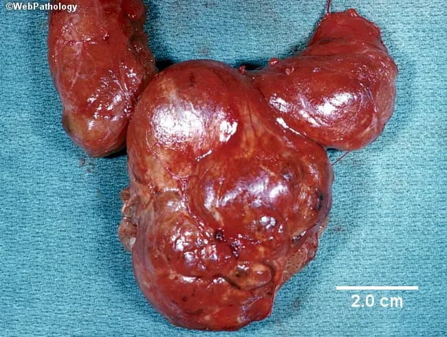 Gross pathology photograph of a total thyroidectomy specimen from a patient with multinodular goiter. The gland is markedly enlarged and lobulated, measuring approximately 12 cm by 10 cm. The external surface is irregular with multiple discrete nodules of varying size that coalesce into a bulky, reddish-brown mass. The cut surface would typically reveal variable nodule architecture with fibrous septa and colloid-filled follicles, consistent with hyperplastic nodular thyroid tissue (multinodular goiter). The overall appearance aligns with sporadic goiter most common in the United States, often euthyroid clinically, though isolated nodules may be hyperfunctioning. Graves disease features such as diffuse hyperplasia with exophthalmos are not observed. No grossly evident malignant cortex features are apparent in this image, although definitive diagnosis requires histology and clinical correlation. Differential considerations include benign nodular disease such as colloid goiter, follicular adenoma, or follicular carcinoma; clinical and radiologic correlation and fine-needle aspiration are recommended if nodules are suspicious. This specimen demonstrates the classic gross appearance of non-toxic multinodular goiter: enlarged gland with nodularity, variable texture, and preserved capsule. This image is valuable for surgical pathology education, medical student teaching, and differential diagnosis demonstrations in endocrinology and thyroid pathology; it supports correlations with thyroid function tests and imaging studies for comprehensive patient management.