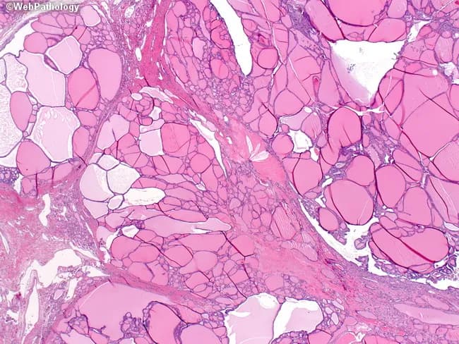 Imaging modality and technique: Bright-field light microscopy of a hematoxylin and eosin–stained thyroid tissue section. Specimen is a thyroid parenchymal biopsy/resection showing multinodular goiter with heterogenous follicle sizes. The micrograph reveals variably sized, dilated follicles interspersed with smaller hypercellular follicles; cells lining some follicles are flattened to cuboidal with scant colloid, while other follicles are large and colloid-rich, producing a biphasic appearance. The stroma is not heavily fibrotic; nodular architecture creates broad fibrous separations. Notable features include very large colloid-containing follicles, uneven distribution, and thickened septa in some areas. Overall thyroid architecture shows nodular hyperplasia without cytologic atypia; there is no invasion or malignant features evident. The image is representative of benign nodular goiter, reflecting long-standing iodine deficiency in some cases or chronic compensatory hyperplasia. Diagnostic significance: demonstrates classic histologic spectrum of multinodular goiter with variable follicle size and colloid content; important to distinguish from follicular neoplasms and inflammatory thyroid disease. Clinical correlation: correlates with clinically enlarging neck mass; usually euthyroid; histology informs management and follow-up. Feature set aligns with common teaching examples for medical education and pathology atlases, enabling search queries for terms such as multinodular goiter, colloid-rich follicles, flattened follicular epithelium, and nodular hyperplasia.