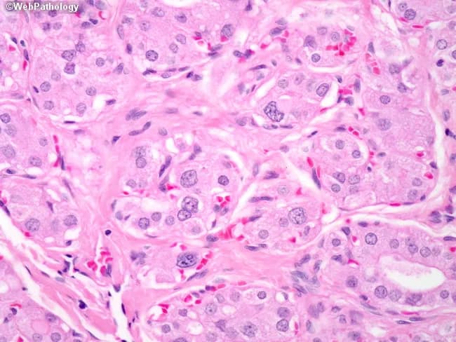 Imaging modality and specimen context: This is a high power light microscopic histology slide of thyroid gland tissue stained with Hematoxylin and Eosin, prepared from a surgically excised or biopsy specimen. Location: cervical thyroid region, thyroid parenchyma comprising follicular epithelium. The slide captures a dyshormonogenetic goiter pattern: hypercellular nodules formed by small, compact follicles, with lumina that are diminutive or nearly occluded and containing little to no colloid. Cytologic atypia is mild to minimal, lacking prominent nuclear features of papillary carcinoma. The background stroma may be edematous or fibrous, with scattered colloid-poor follicular structures. The morphological phenotype reflects defective thyroid hormone synthesis (dyshormonogenesis) with compensatory follicular hyperplasia, and may resemble multinodular goiter but with reduced colloid and more crowded epithelium. Diagnostic significance: histology supports dyshormonogenetic goiter as etiologic basis of congenital or acquired goiter, helps distinguish from autoimmune thyroiditis (lymphocytic infiltrate, germinal centers), Graves disease (diffuse hyperplasia with scalloped colloid), or follicular neoplasm (capsular/vascular invasion absent). Clinical correlation: management typically favors lifelong thyroid hormone replacement; surgical thyroidectomy is reserved for compression symptoms or diagnostic uncertainty. Relevance to clinical practice and research includes understanding thyroid biosynthesis defects, pediatric goiters, and surgical decision-making. Use cases include educational pathology, differential diagnosis practice, and radiologic-pathologic correlation in thyroid disease.