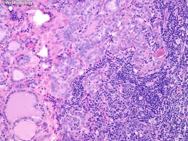 This histopathology image shows thyroid parenchyma with dense lymphocytic infiltration in the interstitium and prominent germinal center formation, captured on a hematoxylin and eosin stained section. The infiltrate is predominantly CD3+ T cells, with a minority of CD20+ B cells and scattered mature plasma cells. Hyperplastic follicles and well-developed germinal centers are evident in the top-center region, accompanied by preserved thyroid parenchyma interspersed with lymphoid aggregates. The histology demonstrates features consistent with autoimmune thyroiditis, classically seen in Graves disease: chronic lymphocytic infiltration with follicular hyperplasia and organized lymphoid architecture. There may be mild disruption of thyroid follicles, with colloid depletion? In Graves, hyperplasia and lymphoid infiltration; However, the image emphasizes lymphoid follicle formation and interstitial T-cell predominance. Diagnostic significance: correlates with autoimmune thyroid disease activity, supports a diagnosis of Graves-related thyroiditis or Hashimoto-like lymphocytic thyroiditis; appropriate differential considerations include Hashimoto thyroiditis with germinal centers, follicular lymphoma should be considered in unusual clonal proliferation, and other inflammatory processes. This image is valuable for education on thyroid histology, autoimmune pathology, and the morphologic spectrum of lymphoid-rich thyroiditis. Potential clinical use cases include medical education, pathology exam review, and correlation with thyroid function tests and autoantibody profiles to evaluate disease activity and treatment response.